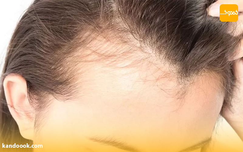 علائم ریزش موی هورمونی