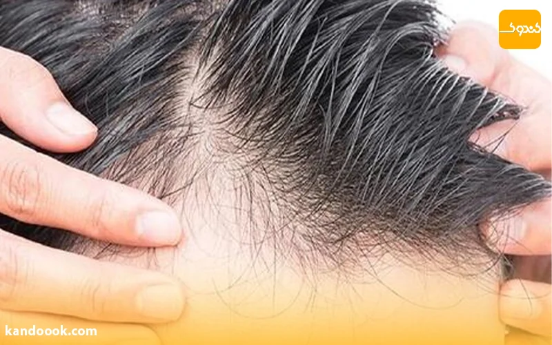 چه عواملی باعث ریزش مو، کم پشتی و نازک شدن موهای سر می شود؟