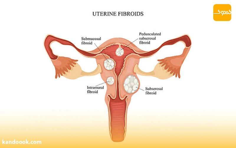 تأثیر فیبروم بر ناباروری چیست؟