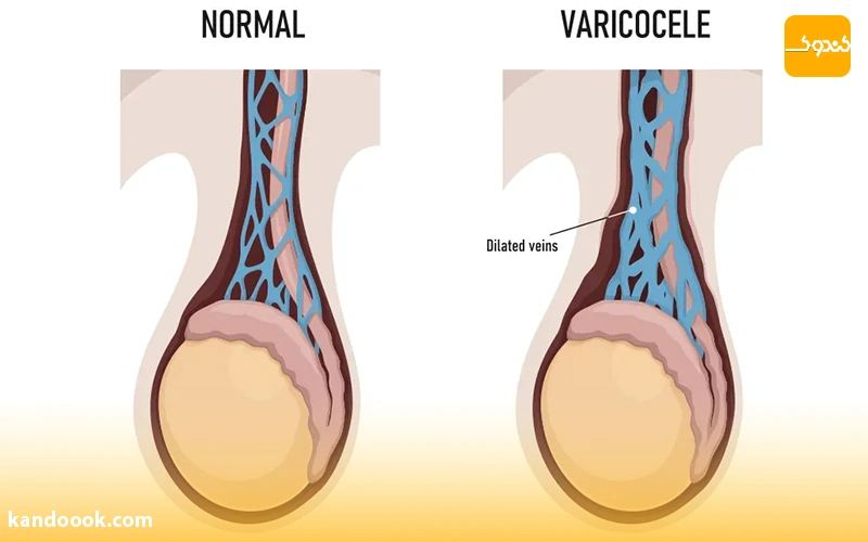 آیا واریکوسل باعث ناباروری می‌شود؟
