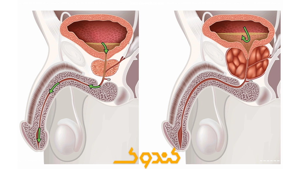 انزال معکوس یا انزال پس رونده چیست؟