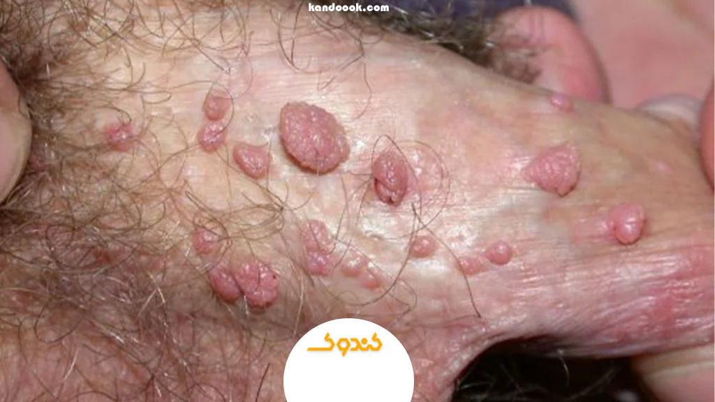 طول عمر ویروس HPV در داخل بدن