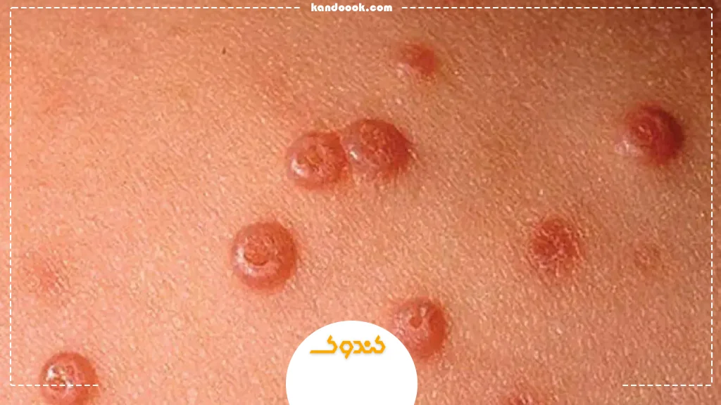 پیشگیری از زگیل تناسلی با استفاده از محصولات طبیعی