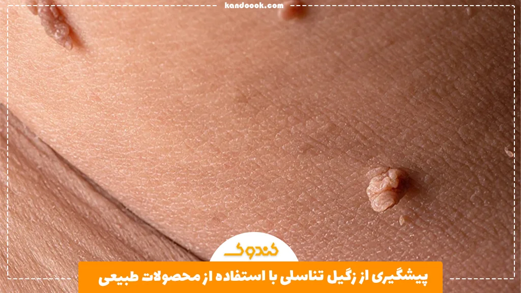 پیشگیری از زگیل تناسلی با استفاده از محصولات طبیعی
