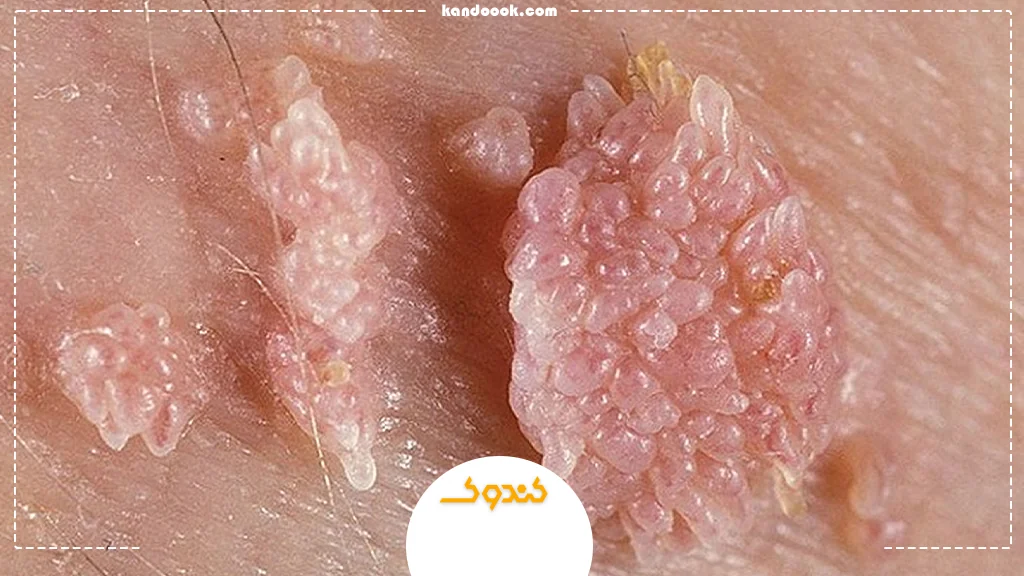 زگیل تناسلی چیست و چه عواملی باعث آن می‌شود؟