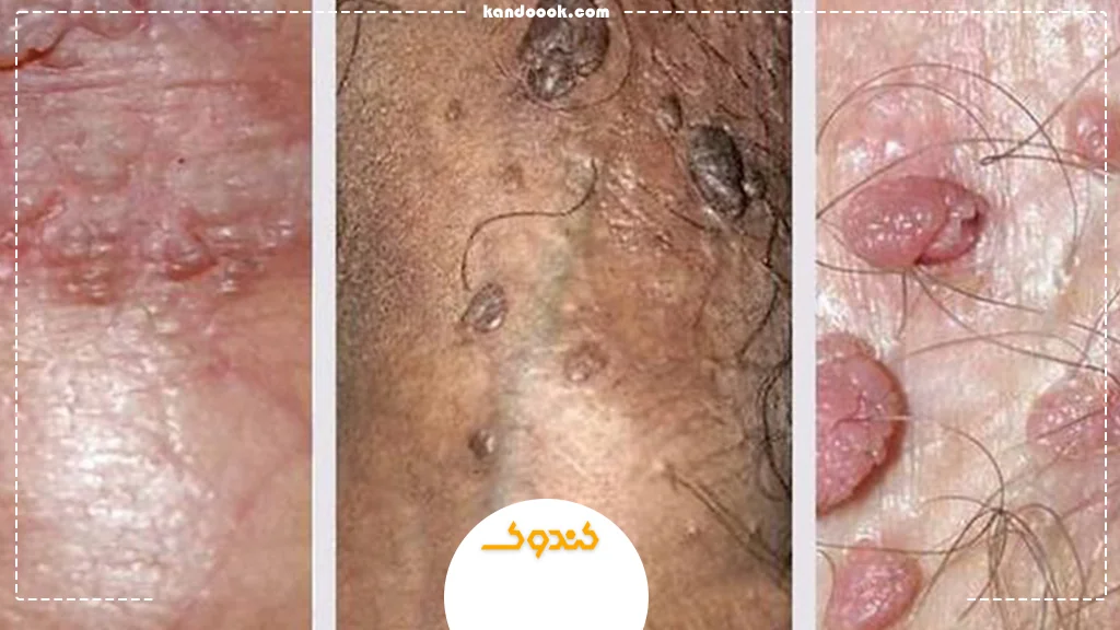 HPV چیست و چگونه به آن مبتلا می‌شویم؟