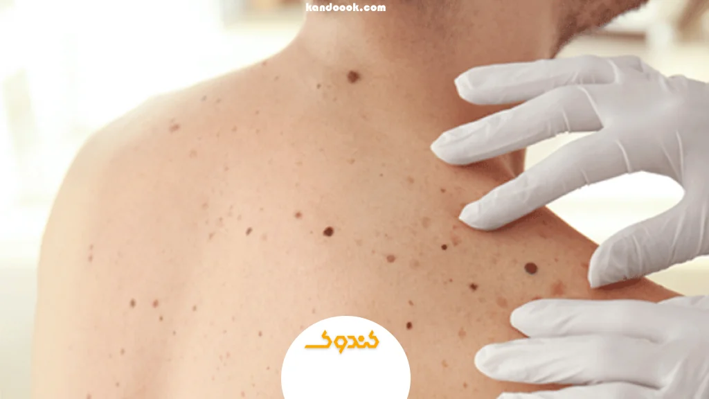 دیدگاه طب سنتی در مورد تاثیر عسل بر ضایعات پوستی