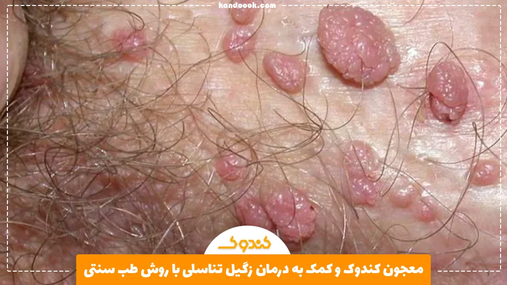معجون کندوک و کمک به درمان زگیل تناسلی با روش طب سنتی