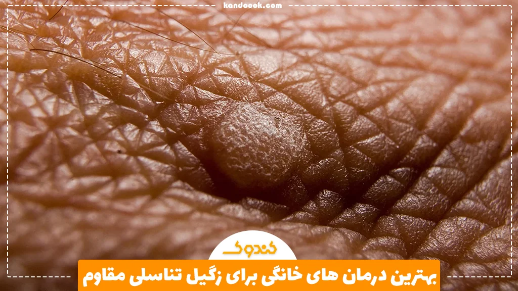 بهترین درمان های خانگی برای زگیل تناسلی مقاوم