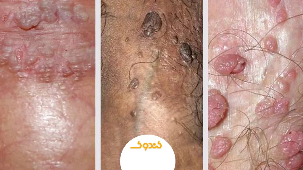 زگیل تناسلی و نقش تقویت سیستم ایمنی در بهبود آن چیست؟