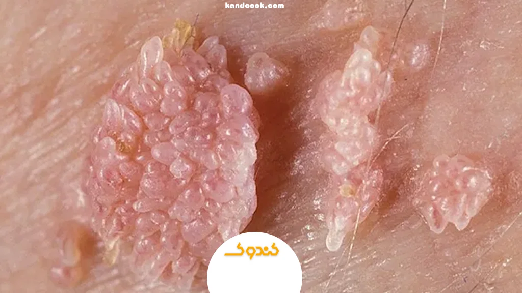 زگیل تناسلی چیست و چرا به آن دچار می‌شویم؟