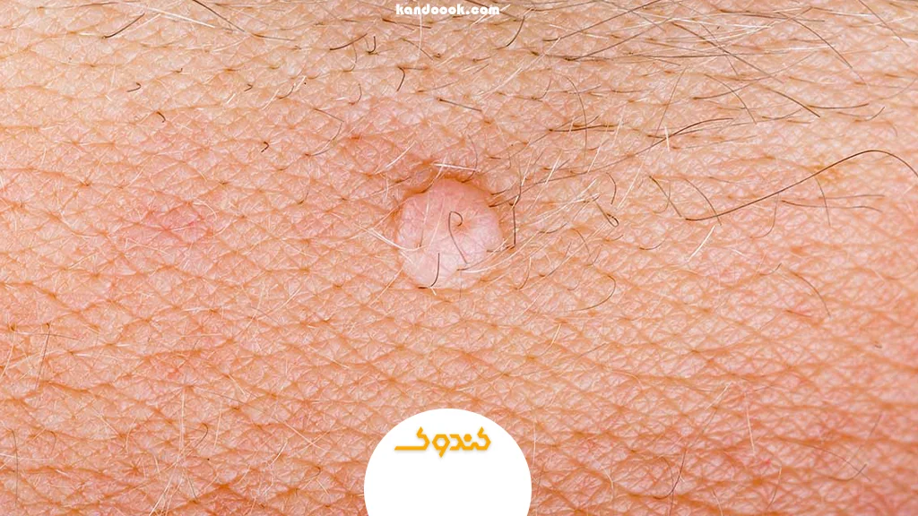 زگیل تناسلی چیست و چرا به آن مبتلا می‌شویم؟