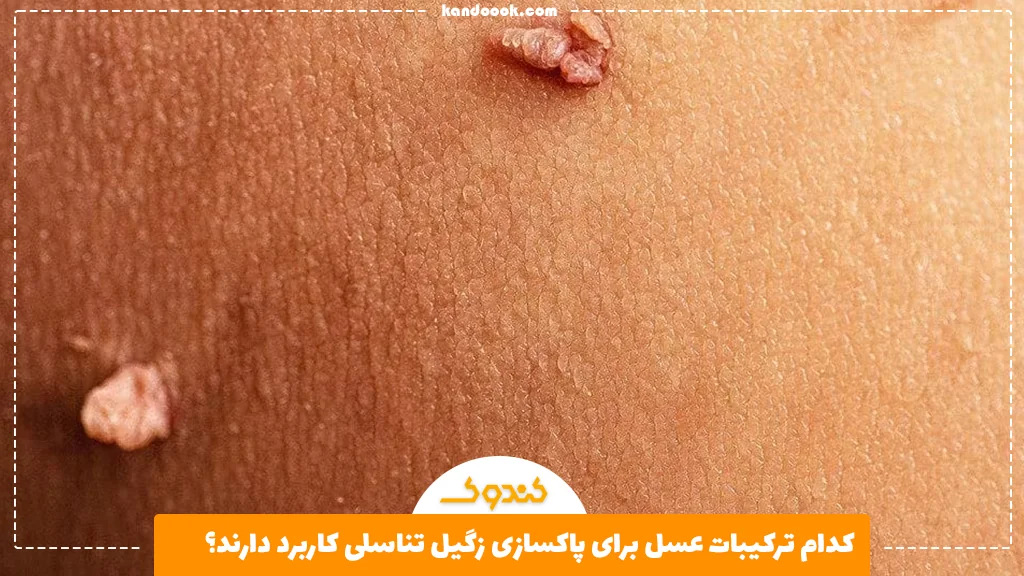 کدام ترکیبات عسل برای پاکسازی زگیل تناسلی کاربرد دارند؟