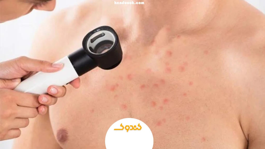 قارچ پوستی چیست و چگونه ایجاد میشود