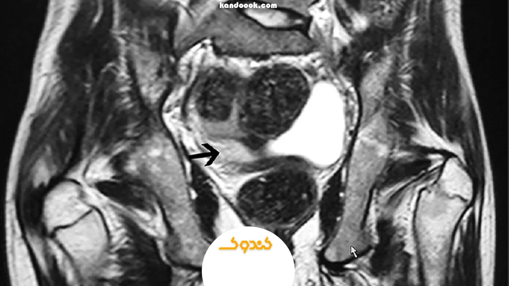 MRI رحم و لگن