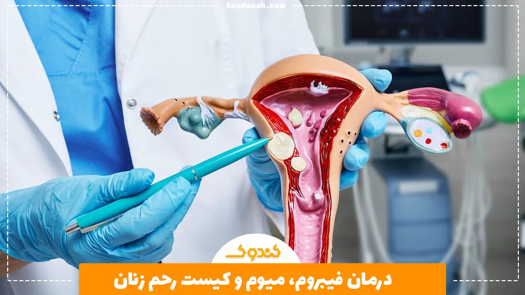 درمان فیبروم، میوم و کیست رحم زنان