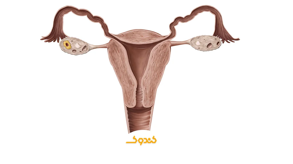 فیبروم، میوم و کیست رحم چیست و چرا ایجاد میشود؟