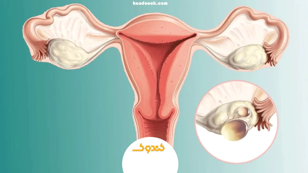 عوامل دیگر مؤثر در ایجاد کیست تخمدان