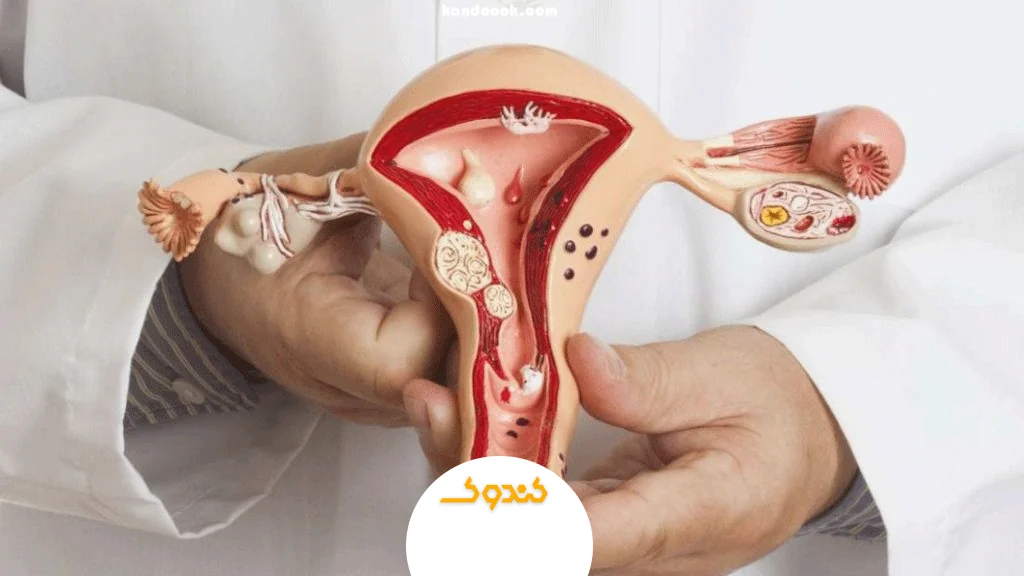 کیست تخمدان چیست؟