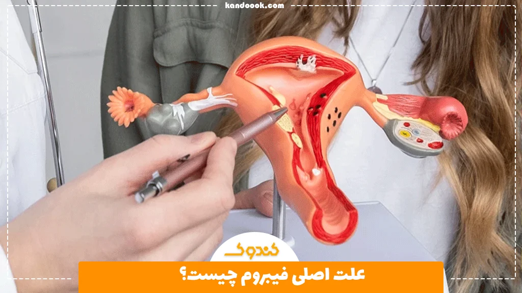 علت اصلی فیبروم چیست؟