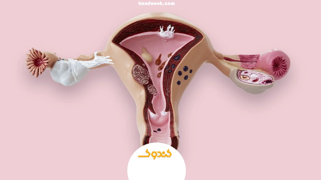 میوم رحم چیست؟