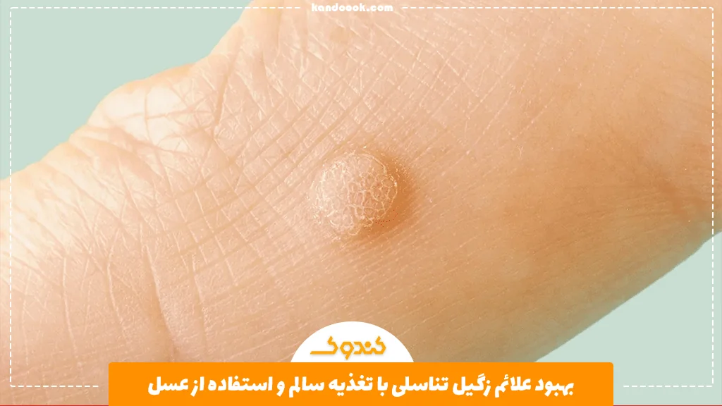 بهبود علائم زگیل تناسلی با تغذیه سالم و استفاده از عسل