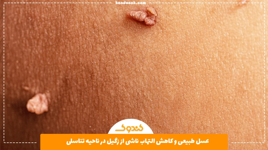 عسل طبیعی و کاهش التهاب ناشی از زگیل در ناحیه تناسلی