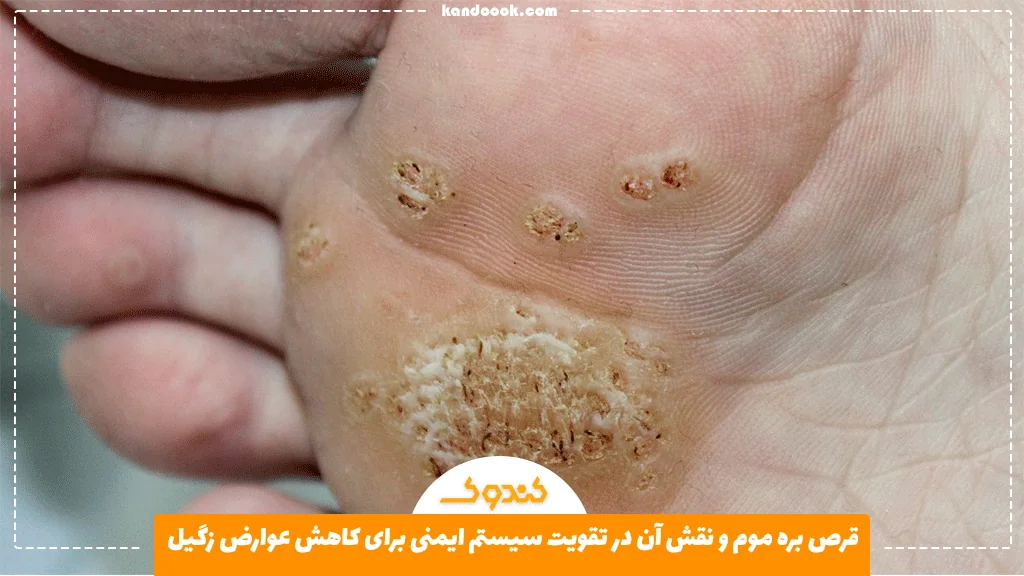 قرص بره موم و نقش آن در تقویت سیستم ایمنی برای کاهش عوارض زگیل