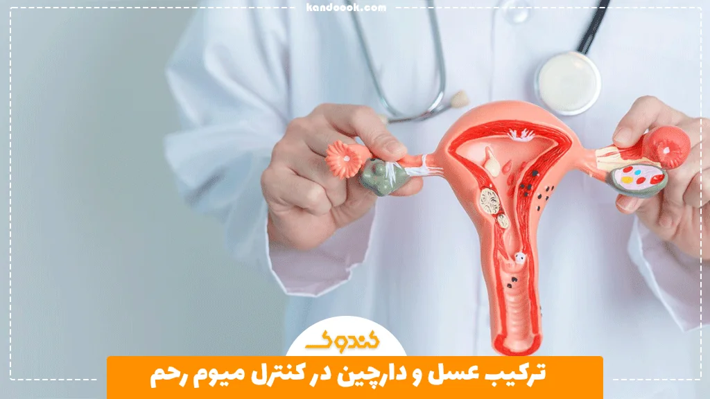 ترکیب عسل و دارچین در کنترل میوم رحم