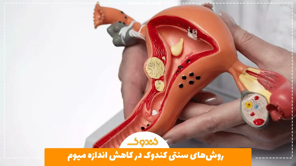 روش‌های سنتی کندوک در کاهش اندازه میوم